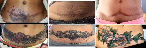 Scar-Concealment-Tattoos